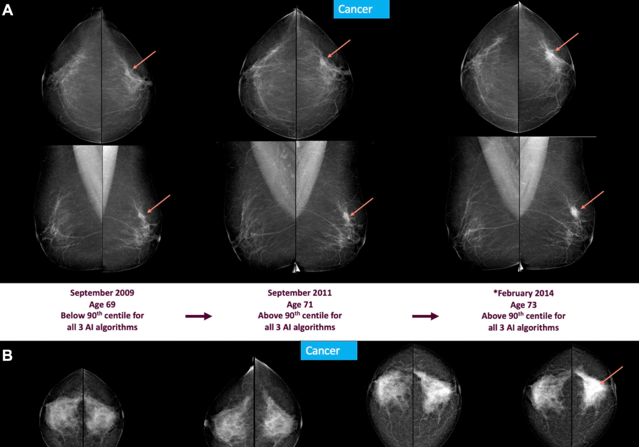 Promising Study: Artificial Intelligence Detects Breast Cancer Up to Six Years Before Diagnosis