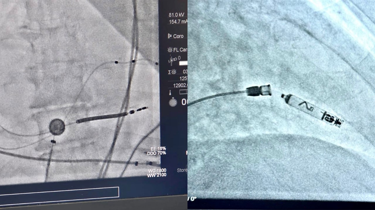 Two significant firsts in Cyprus in the field of cardiology by Nicosia General Hospital